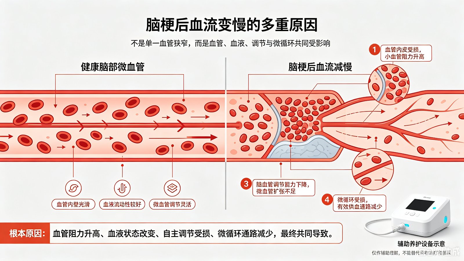 脑梗患者血液流速慢的根本原因是什么?